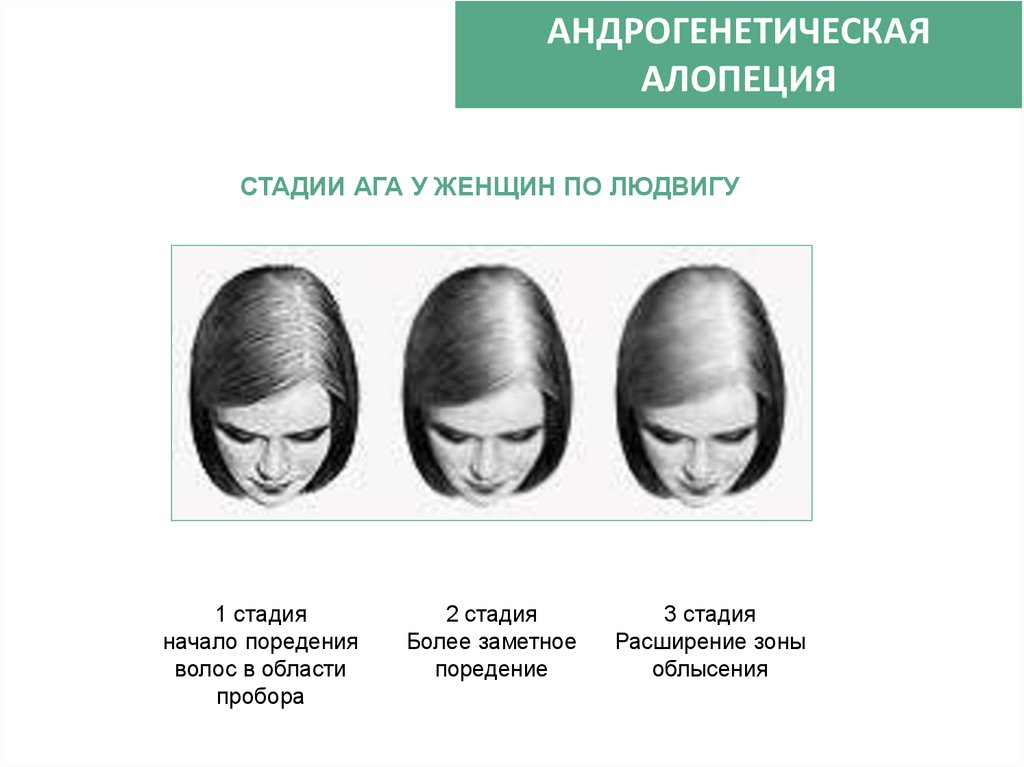 Выпадение волос –  причины, диагностика, современное лечение