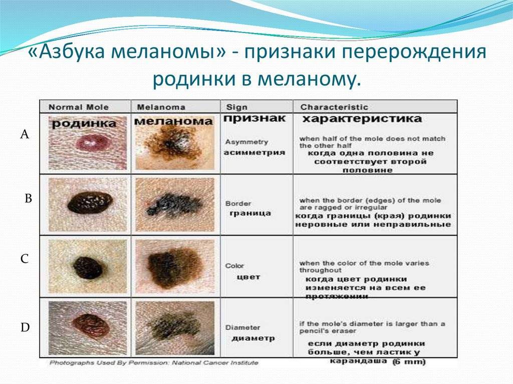 Можно удалять родинки и как это правильно делать