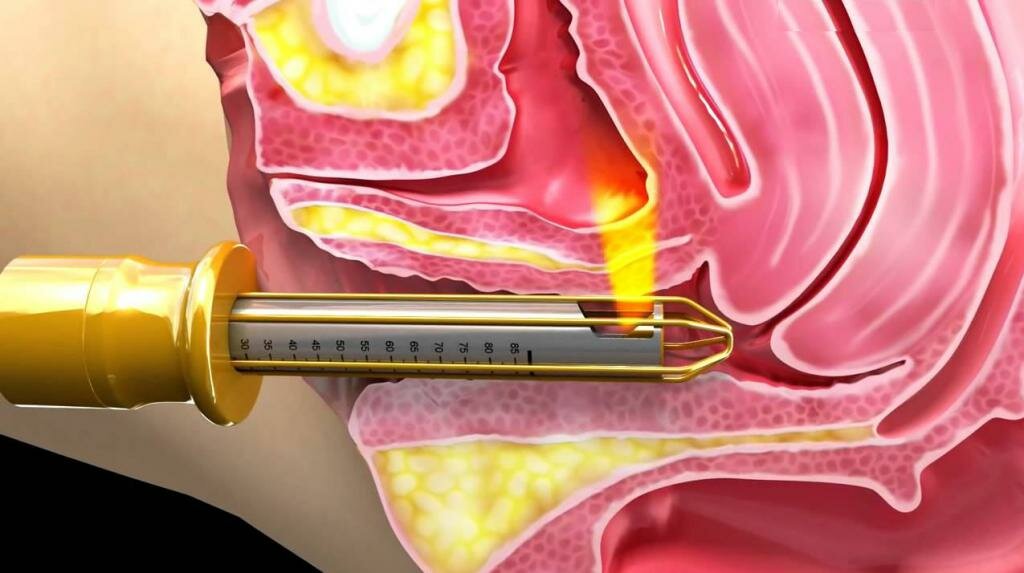 Вульво-вагинальное лазерное омоложение monalisa touch. лечение вагинальной атрофии в санкт-петербурге.
