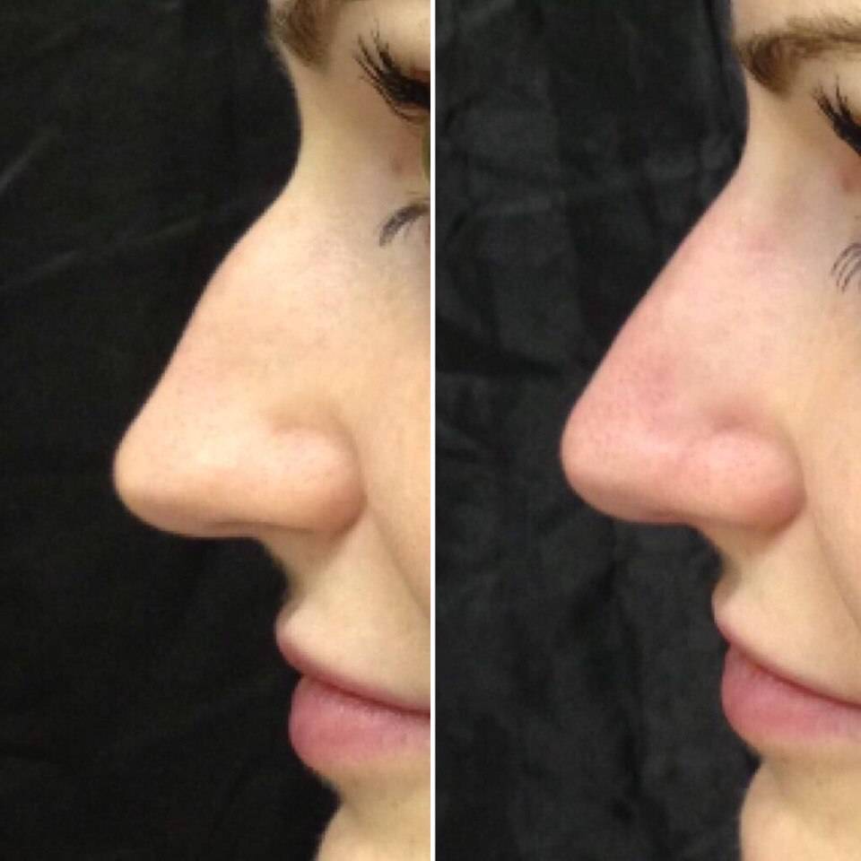 Безоперационная ринопластика, пластика носа без операции – фото до и после, отзывы и видео