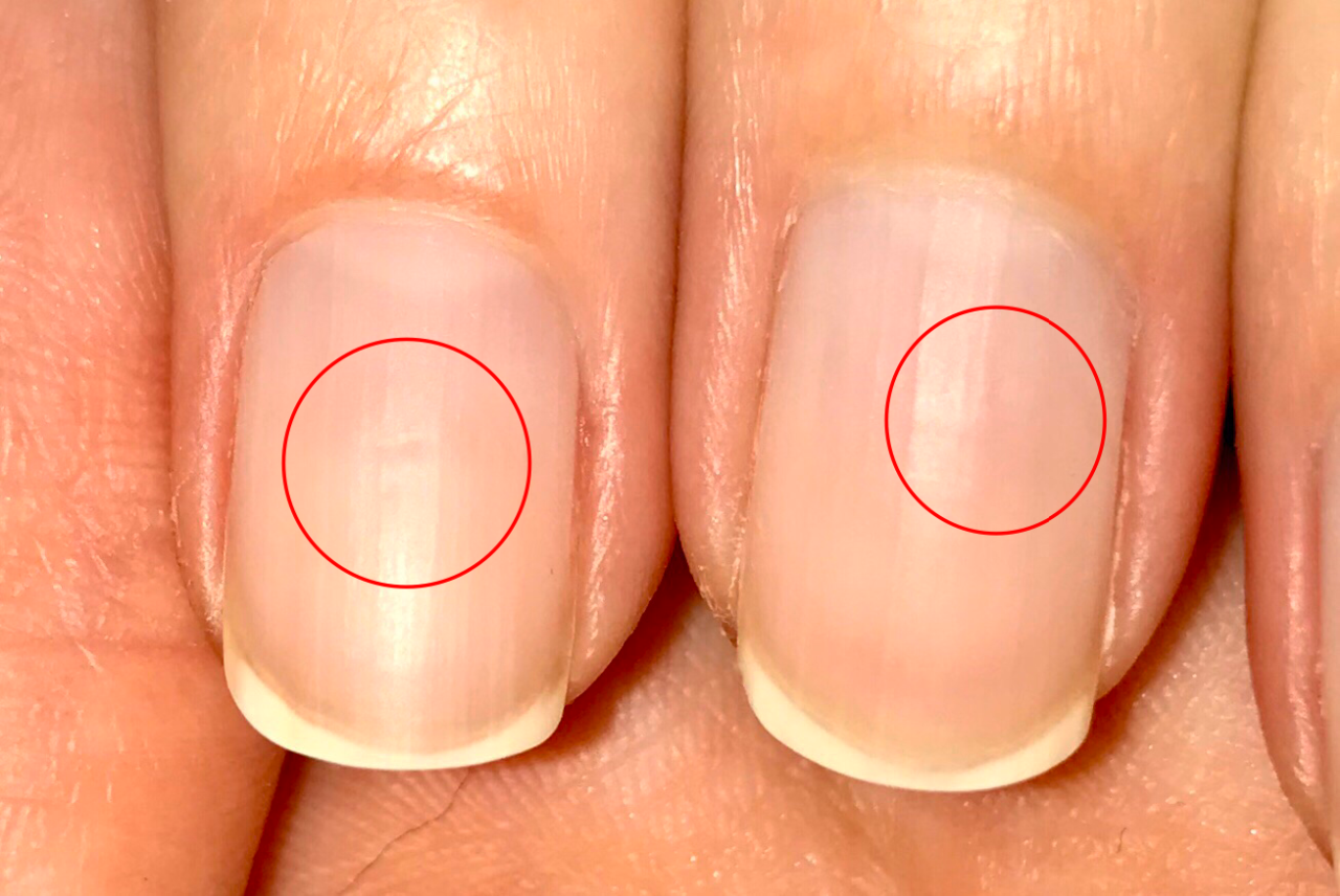 Почему на ногтях появляются продольные. Продольная меланонихия. Продольная ногтевая меланонихия. Продольные полосы на ногтях.