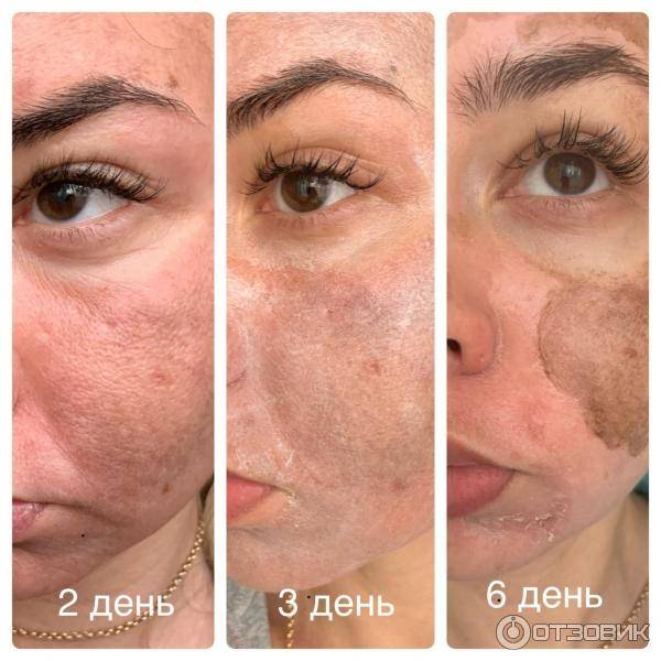 10 причин, почему вы должны сделать химический пилинг у косметолога