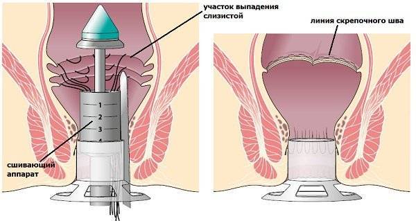 Перинеопластика – пластика влагалища после родов
