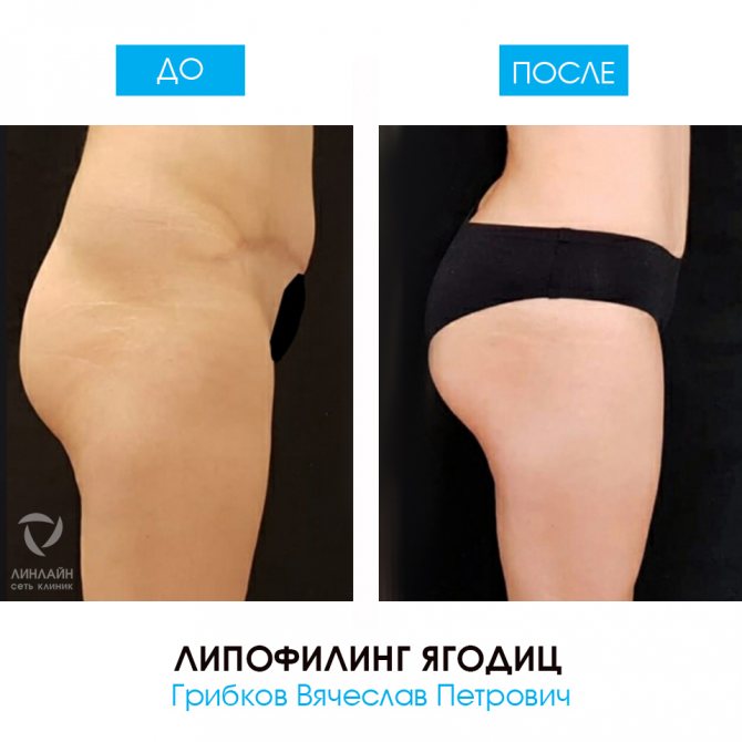 Липофилинг Грудных Желез Отзывы Фото