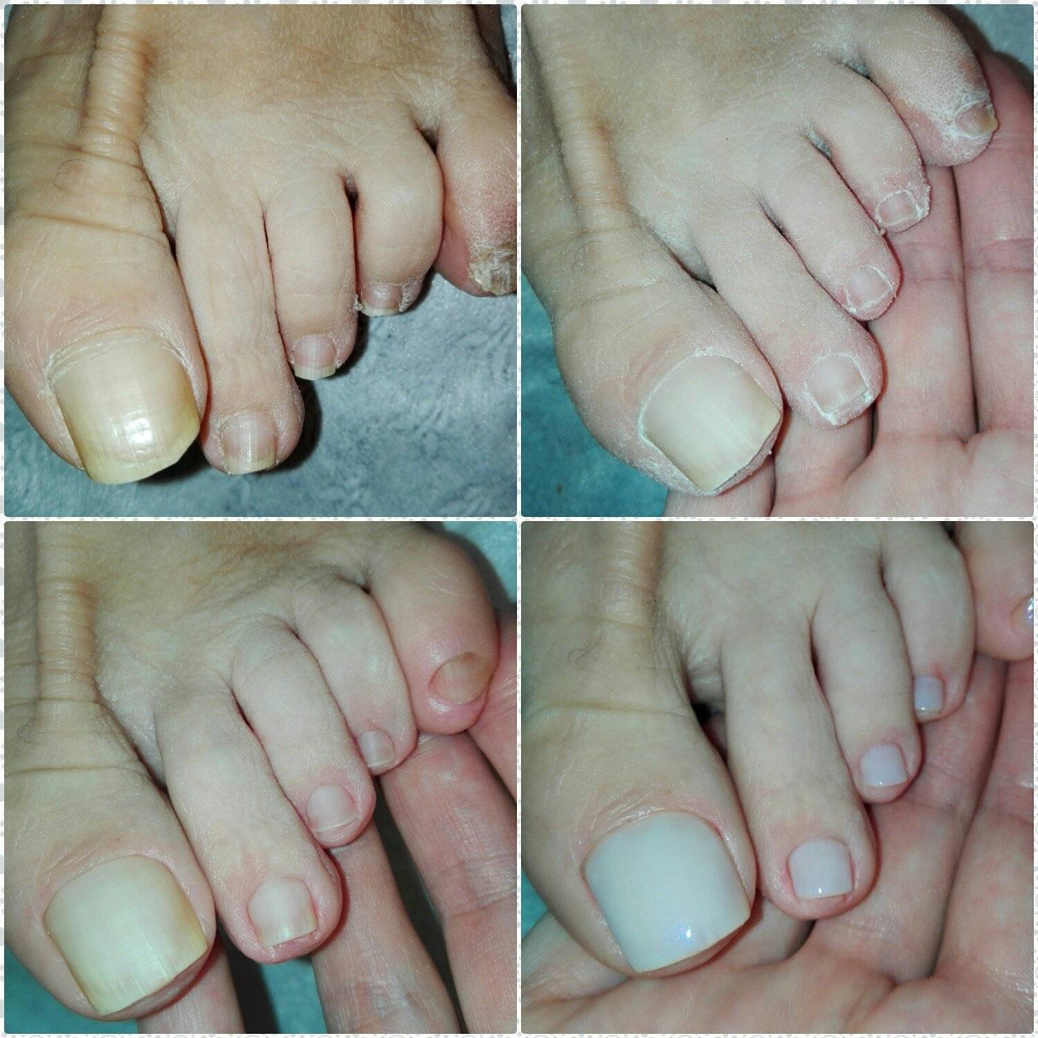 Наращивание ногтей на ногах гелем, полигелем. фото до и после, видео, как делать в домашних условиях