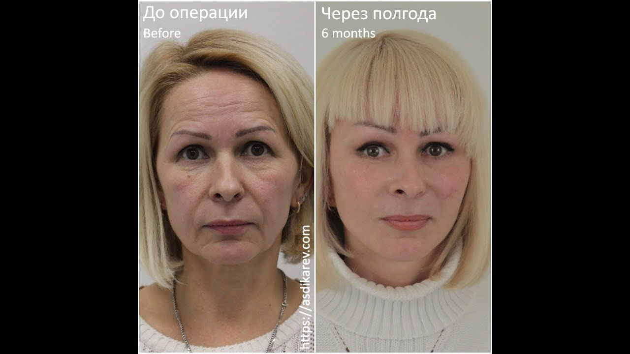 Круговая подтяжка лица - виды, обзор операции, отзывы + фото до и после