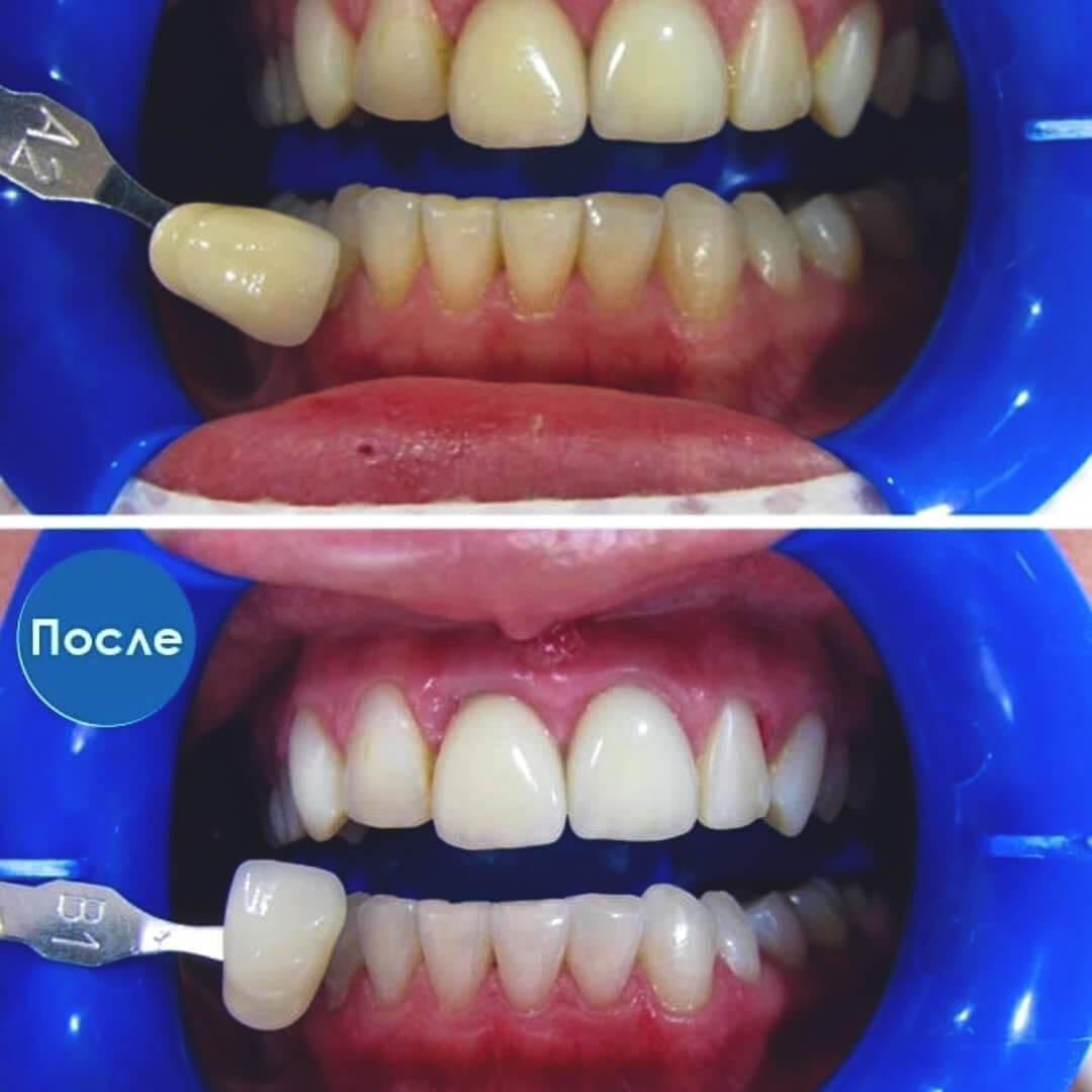Как работает технология отбеливания зубов zoom 4 - в чем плюсы и минусы отбеливания зубов zoom 4
