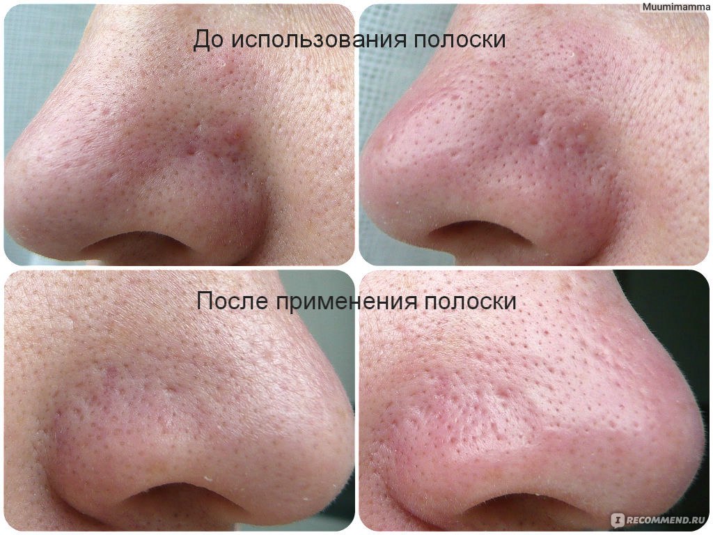 Как сузить поры на коже: советы косметологов :: syl.ru