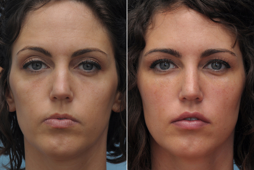 Биоревитализация губ. отзывы, что это, фото до и после, эффект процедуры