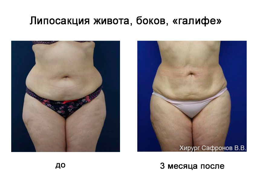 Липосакция в клинике санкт-петербурга | стоимость операции липосакции, отзывы,  фото до и после