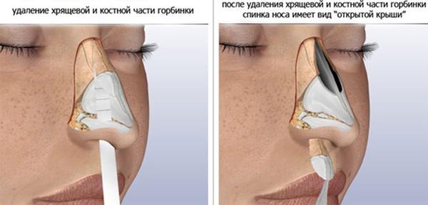 Исправление формы носа с помощью филлеров
