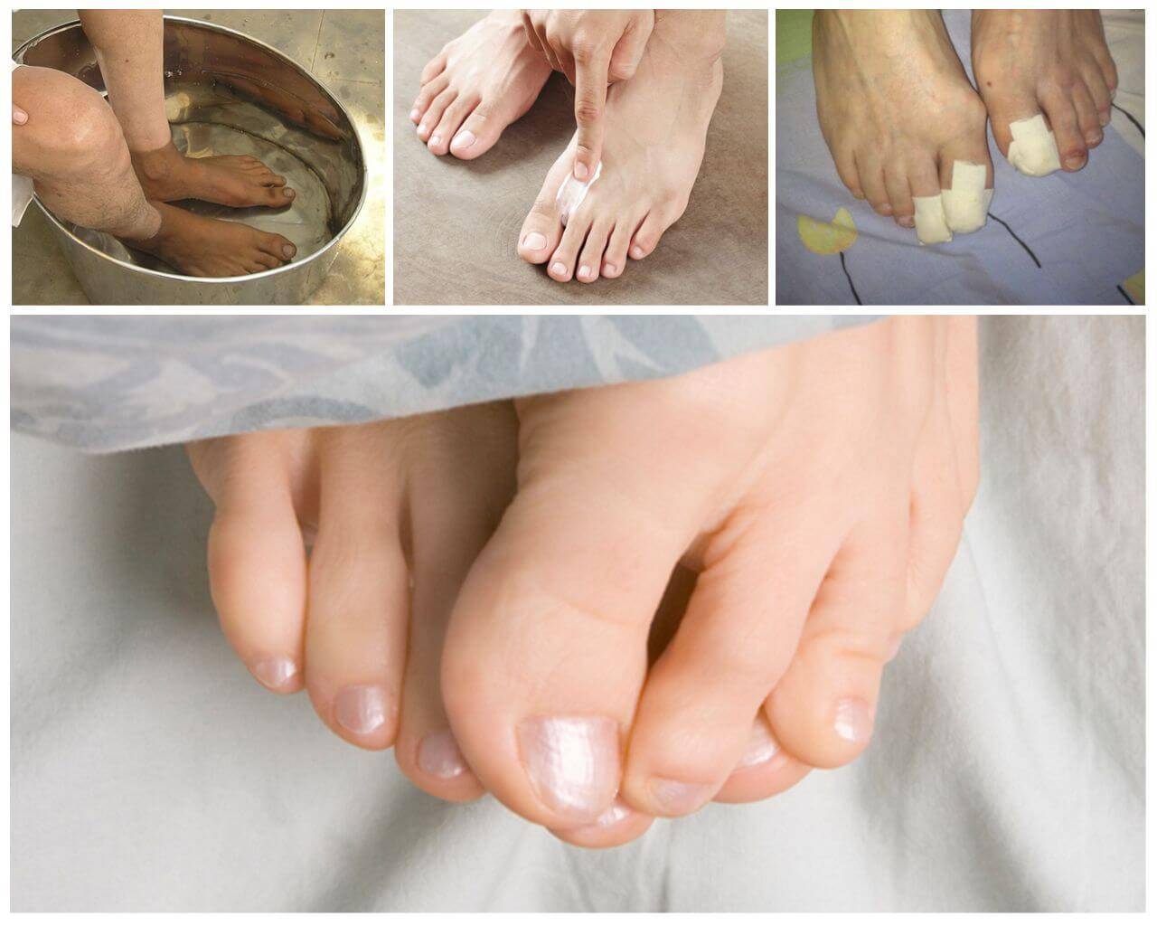 Онихомикоз: профилактика грибка ногтей