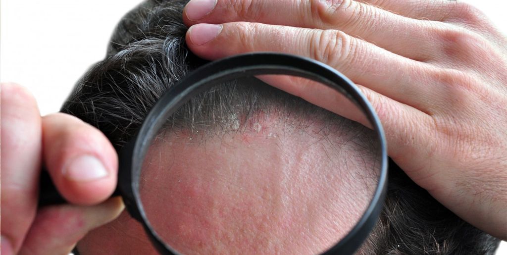 Псориаз волосистой части головы – симптомы и диагностика