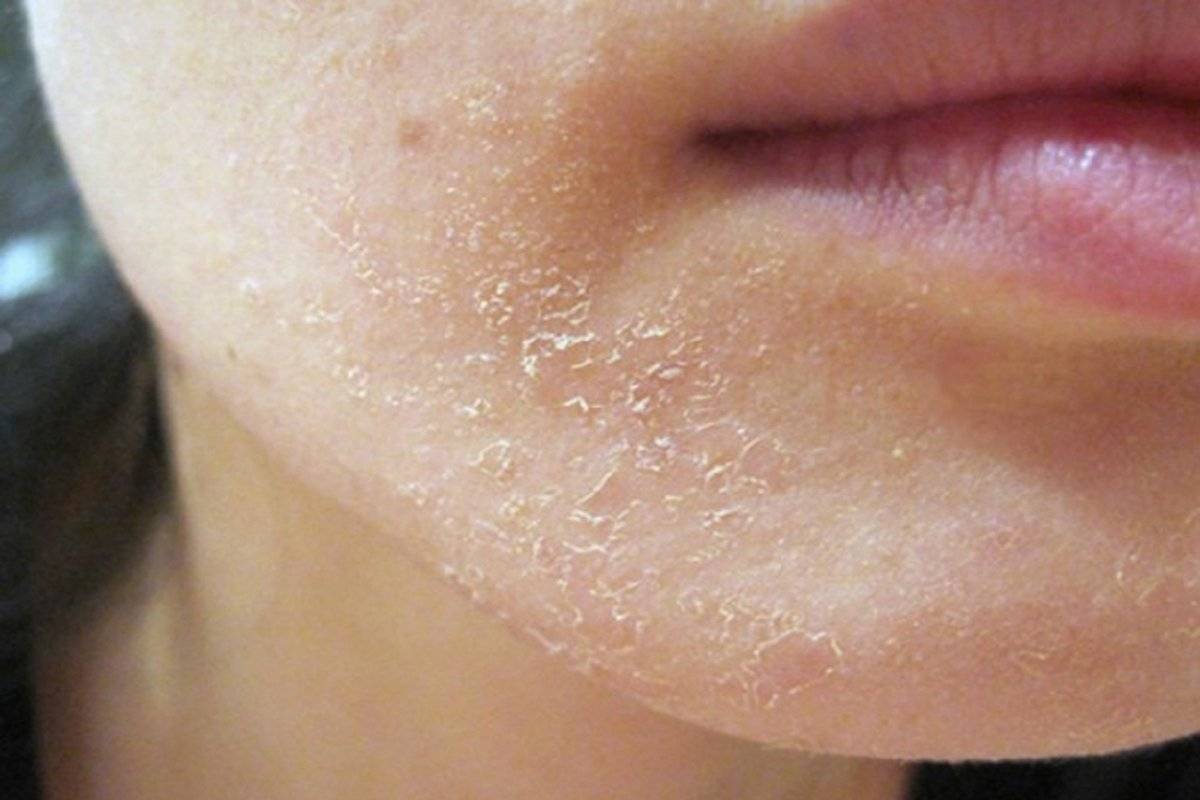 Как избавиться от сухости кожи вокруг рта