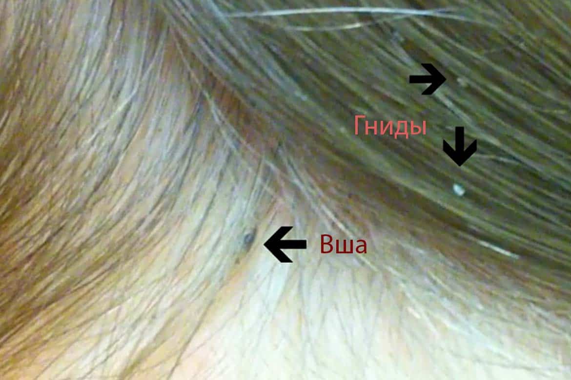 Насекомые в волосах: виды, пути появления, симптомы и способы борьбы
