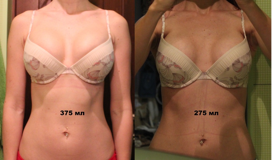 Маммопластика до и после, фото с описанием что это за операция, отзывы