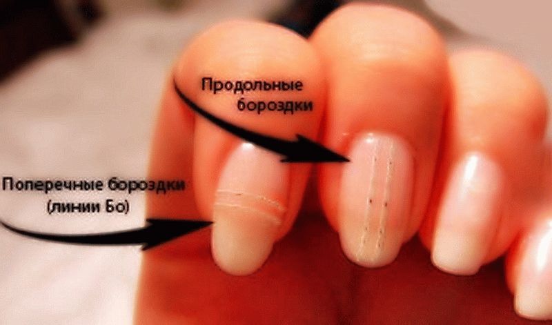 Болезни ногтей