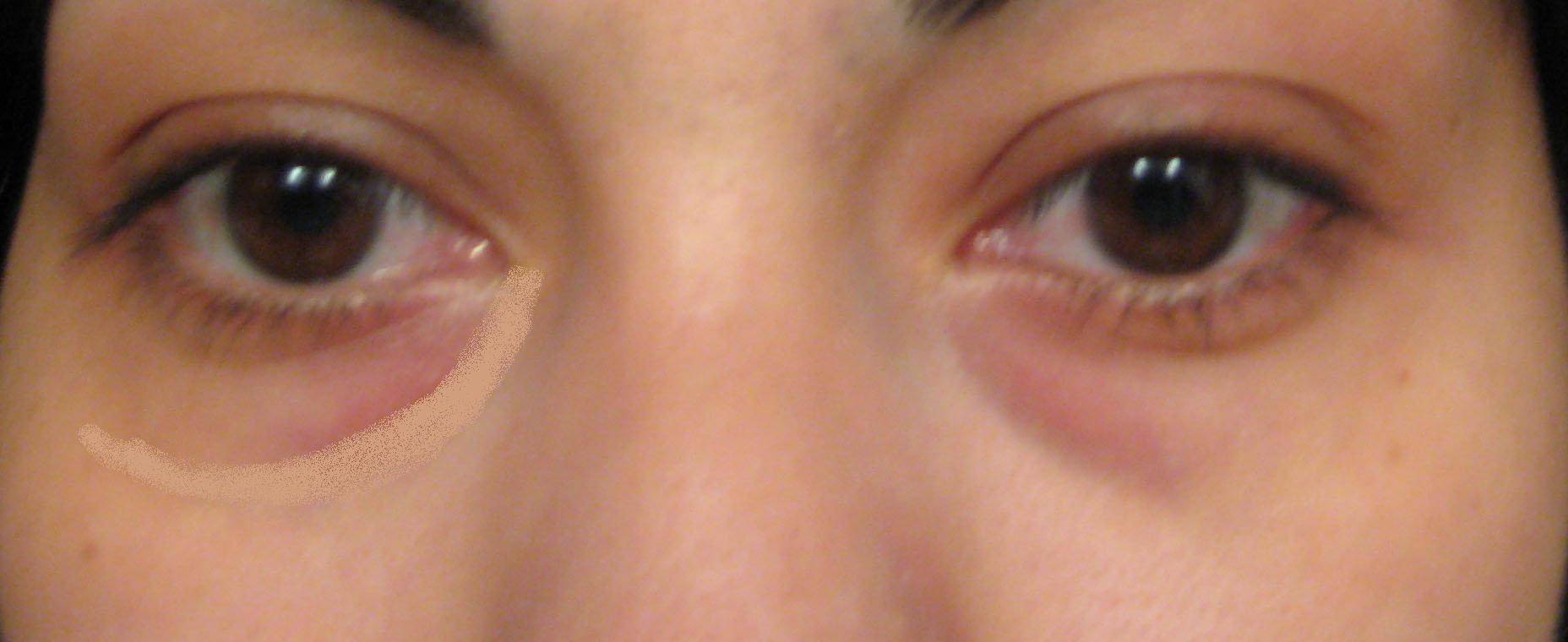 Мешки под глазами - причины и лечение у детей и взрослых. - moscoweyes.ru - сайт офтальмологического центра "мгк-диагностик"