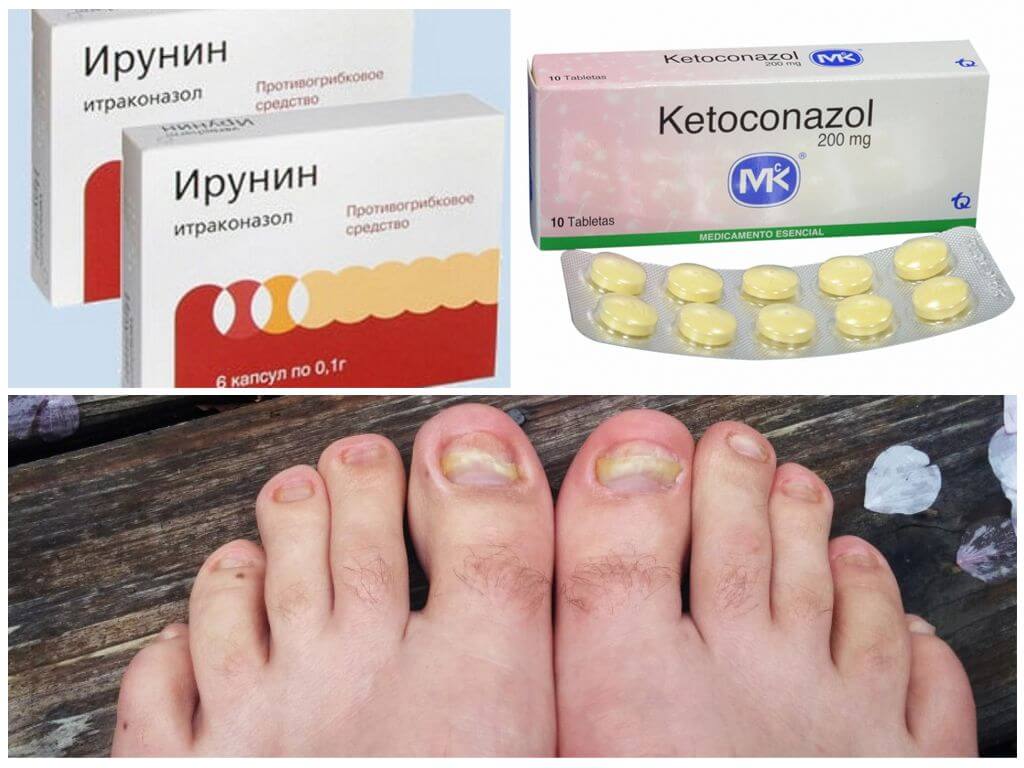 Чем опасны грибковые заболевания и как от них уберечься?