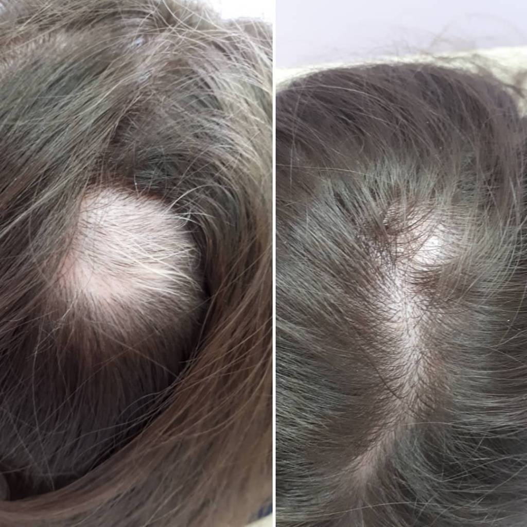 «раньше такого не видели»: врач-трихолог – об особенностях постковидного выпадения волос