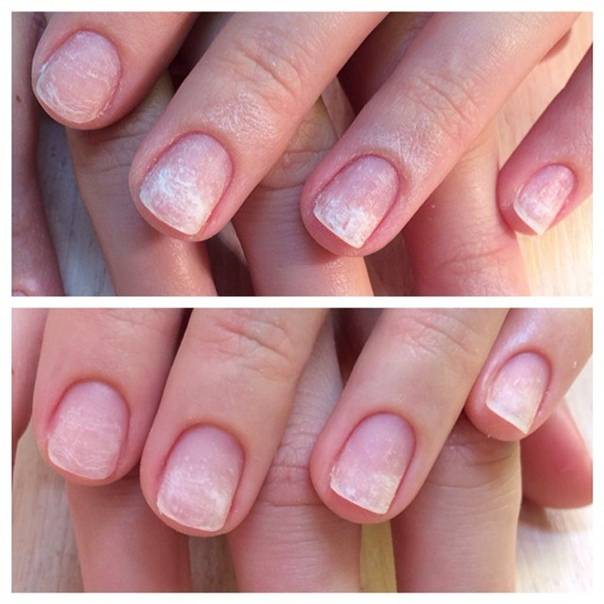 Грибок ногтей на руках - вопрос дерматологу - 03 онлайн