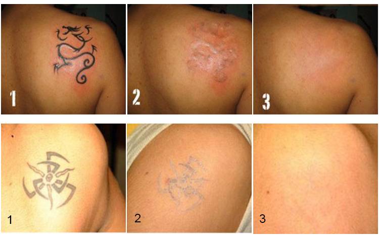 Способы удаления татуировок: 6 проверенных методов | блог Permanent Profy - Permanent Profy