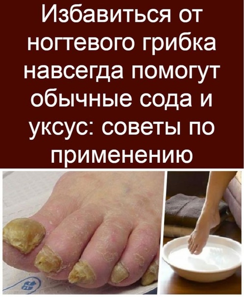 Грибок ногтей на ногах — средства для лечения