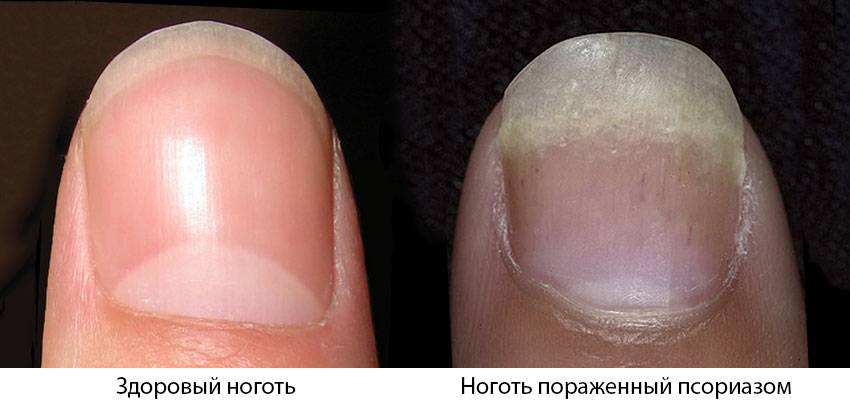 Псориаз ногтей — симптомы, диагностика и методы лечения | альтермед