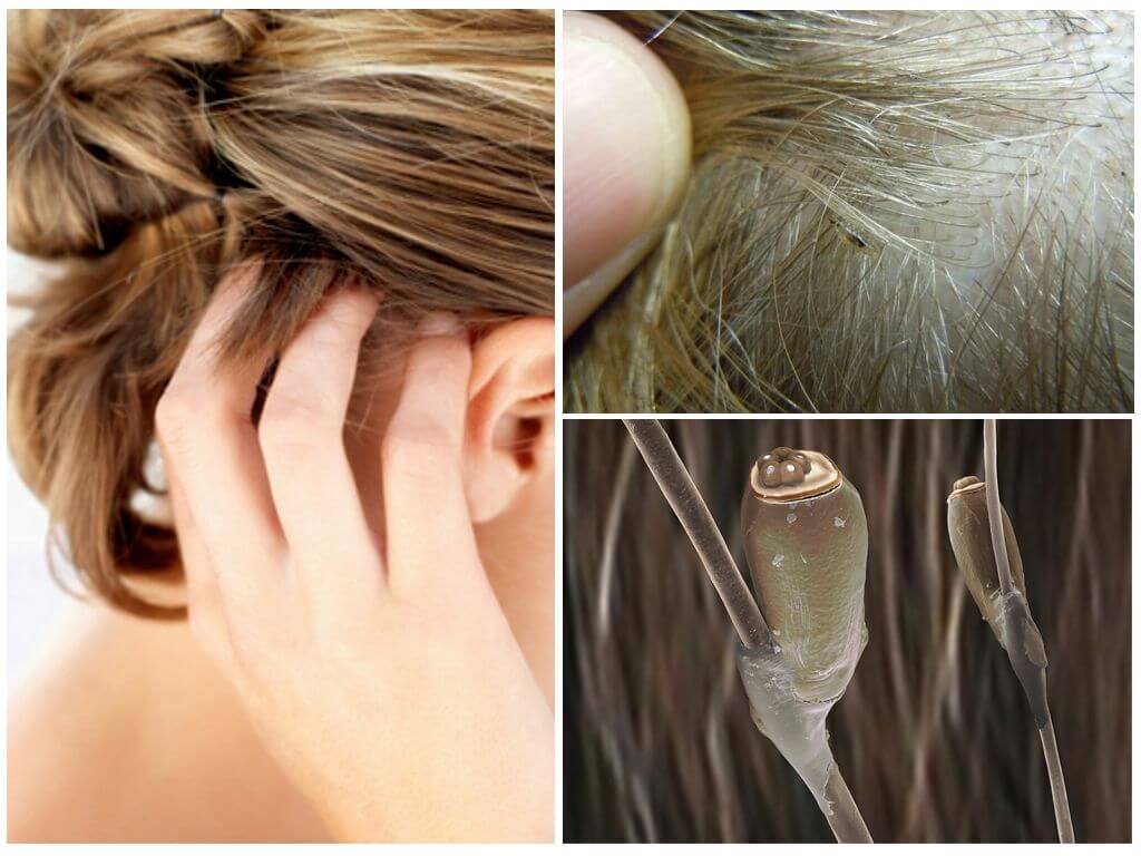 Сухие гниды на волосах: как отличить мертвые и живые, как убрать