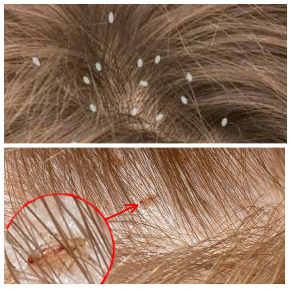 Фото, как выглядят вши и гниды на голове у человека: белые крупинки на голове