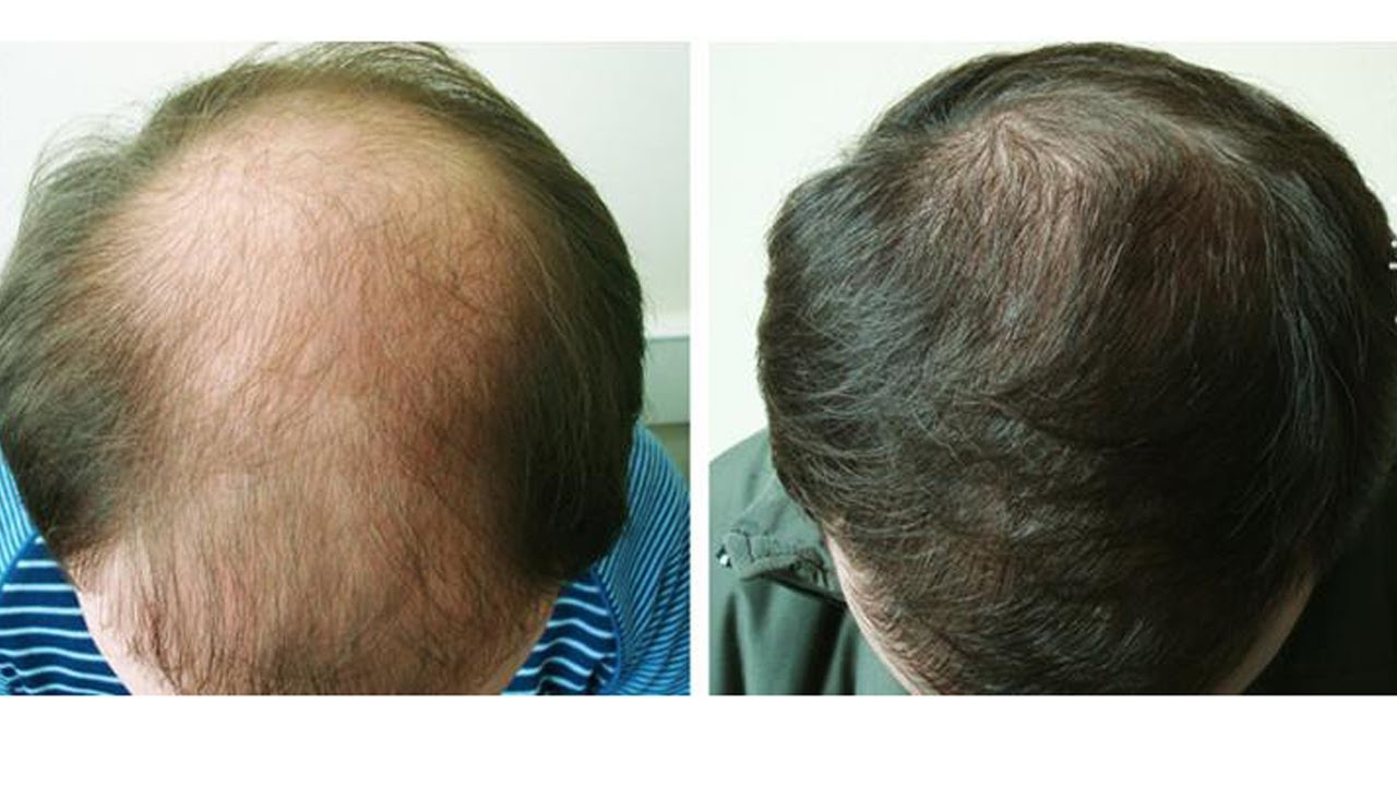 Восстановление волос у мужчин