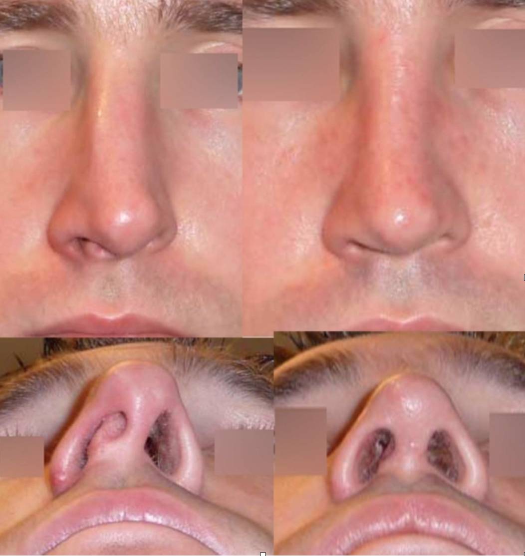 Септопластика носа — операция по исправлению носовой перегородки