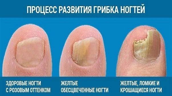 Паронихия - воспаление вокруг ногтя