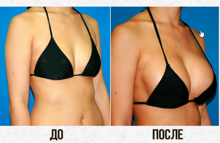 Пластика груди:  фото до и после
