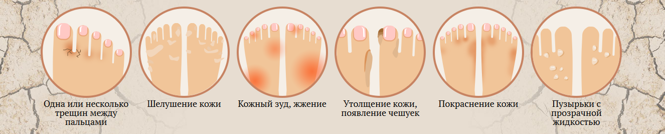 Шелушение кожи на большом пальце ноги