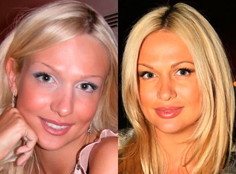 Лопырева виктория: до и после пластики +фото без макияжа и фотошопа