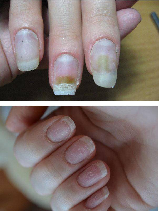 Как восстановить ногти после наращивания в домашних условиях » womanmirror
как восстановить ногти после наращивания в домашних условиях