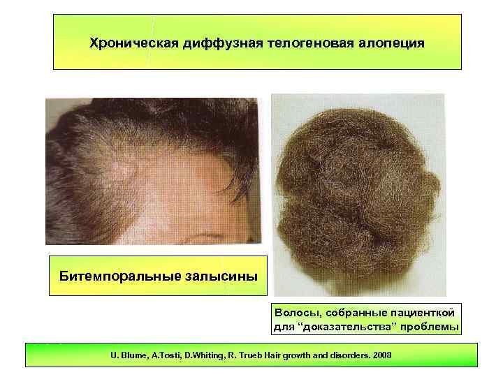 ▷ диффузная алопеция: причины и лечение - clinicana