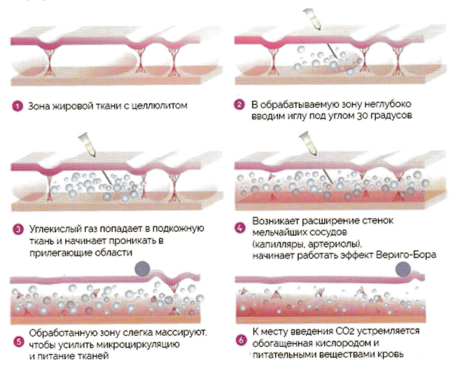 Карбокситерапия уколы углекислым газом фото до и после