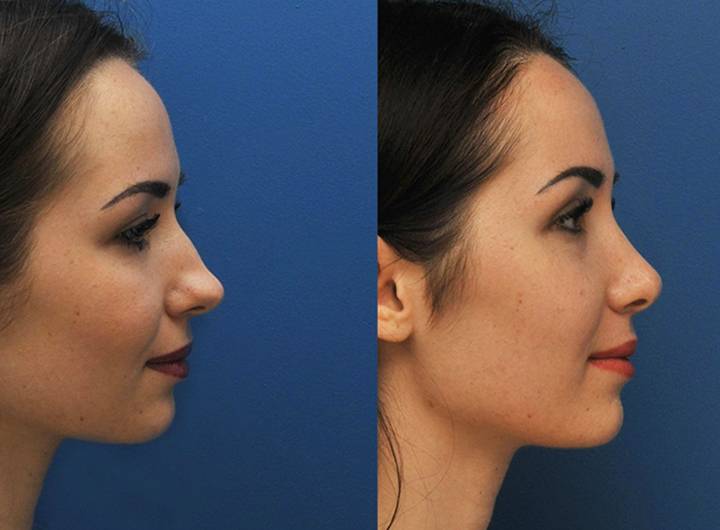 Какие результаты дает пластика кончика носа? фото до и после