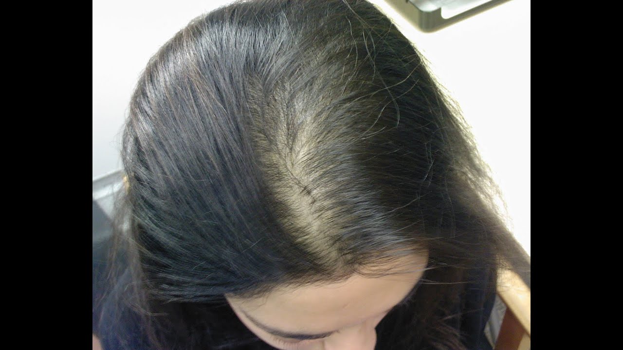 Андрогенная алопеция у женщин: что это такое, фото, симптомы и основные причины андрогенетического выпадения волос