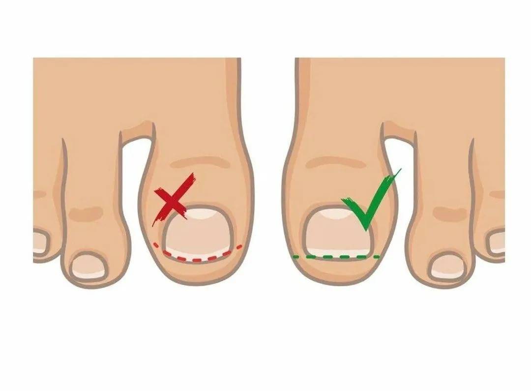 Как размягчить и подстричь ногти на ногах у пожилого человека?