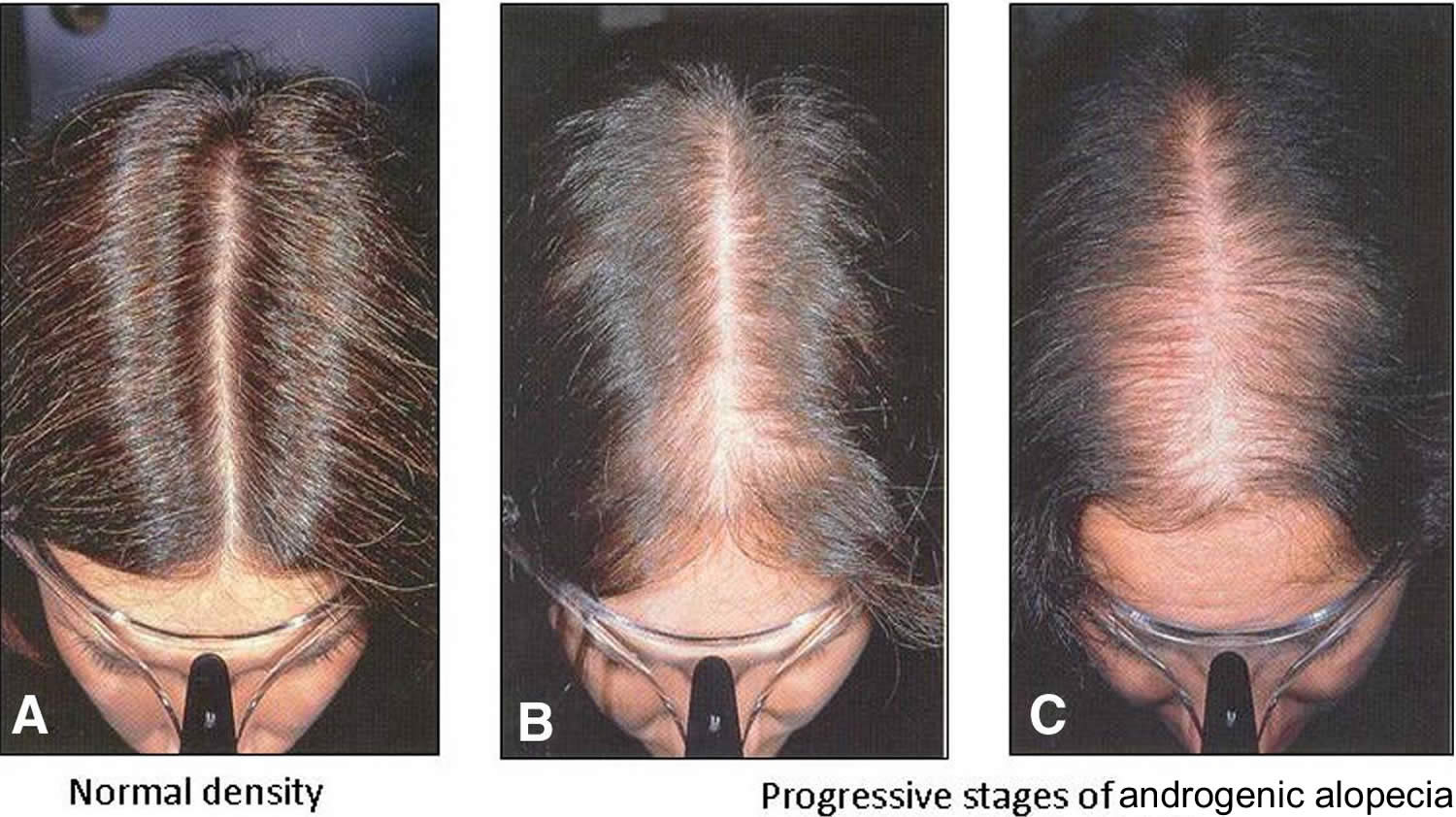 Что такое андрогенная алопеция. Дарсонваль алопеция андрогенная. Андрогенетическая алопеция у женщ. Гиперандрогенная алопеция. Андрогензависимая алопеция.