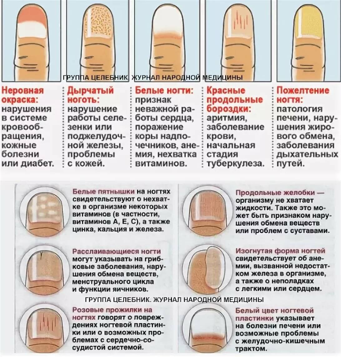Полосы на ногтях - какие бывают и почему появляются, способы терапии, правила ухода и питания