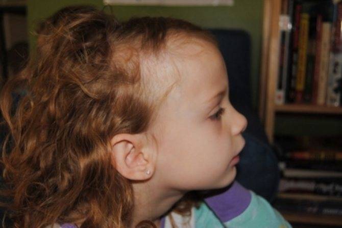 Очаговая алопеция у детей - причины и лечение гнездной алопеции у детей