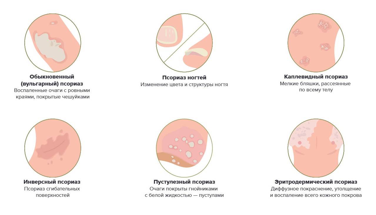 Лечение псориаза на голове в клинике в москве | без гормональных препаратов, ремиссия до 5-6 лет