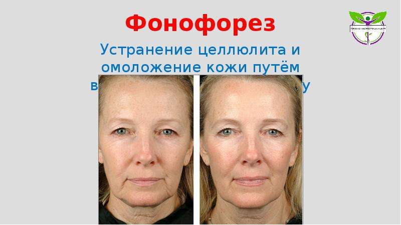 Фонофорез в косметологии: показания и противопоказания ультрафонофореза для лица