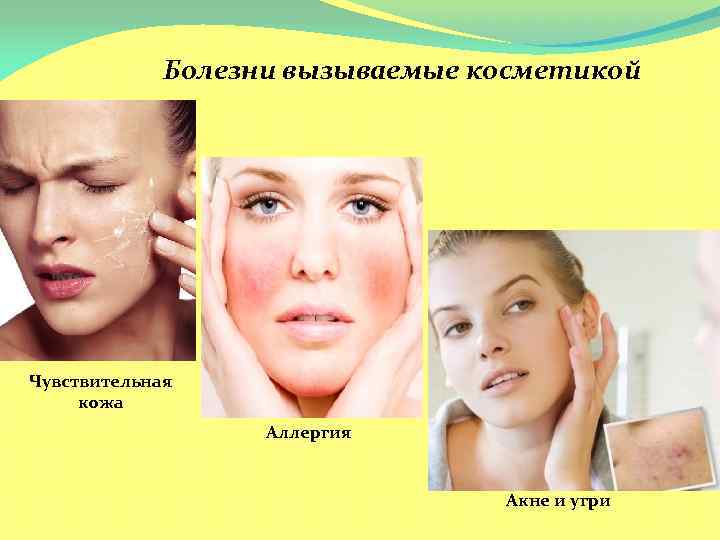 Аллергия на косметику на глазах и веках: симптомы, причины, лечение каплями, профилактика