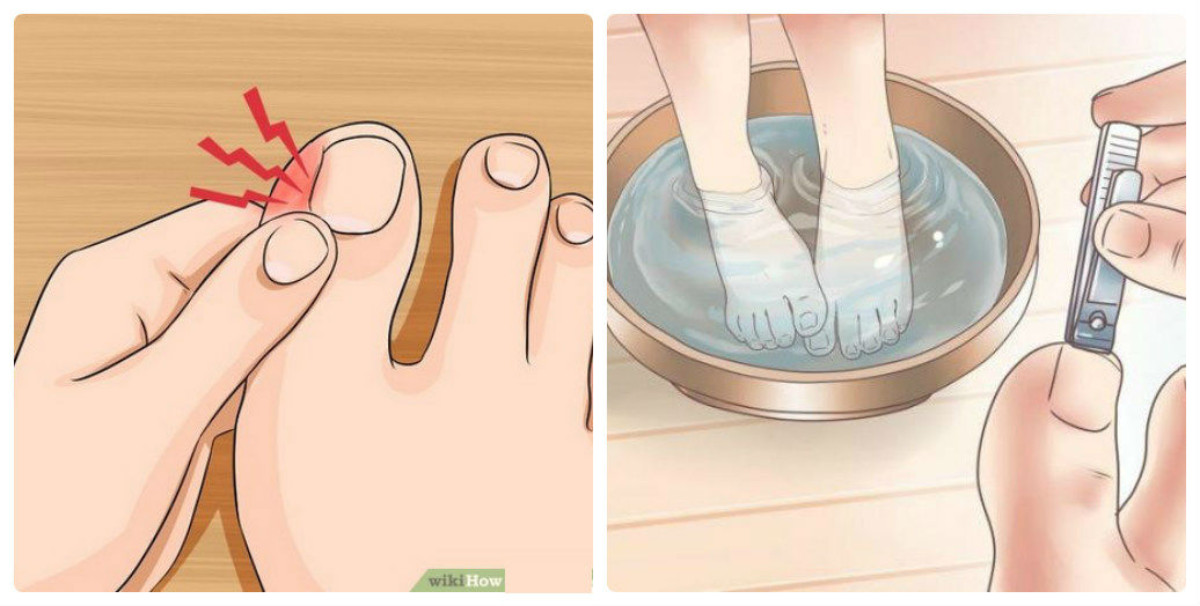 Как правильно подстричь вросший ноготь на ноге в домашних условиях