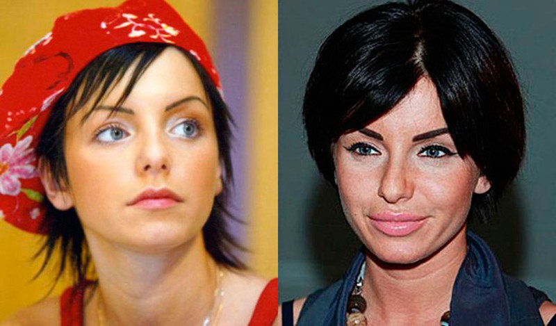 Российские знаменитости до и после пластики фото